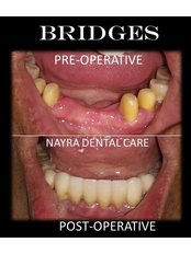 Crown and Bridge_Hisar_Best Dental Clinic - Nayra Dental Care