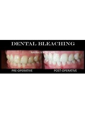 Tooth Whitening_Hisar - Nayra Dental Care