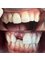 Alux Dental - Single Tooth Implant in One Day 