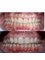 Alux Dental - Gummy Smile Correction 