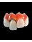 Alux Dental - Multiple Implant with individual teeth 