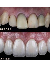 Dental Crowns - Dr Jaydev Dental Clinic