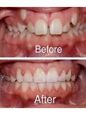 Braces - Dr Jaydev Dental Clinic