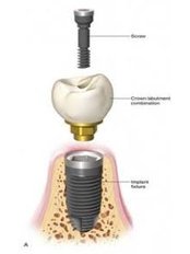 Restoration of Implants - ELEDENT INTERNATIONAL DIGITAL DENTISTRY
