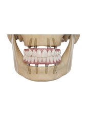 All-on-4 Dental Implants - ELEDENT INTERNATIONAL DIGITAL DENTISTRY