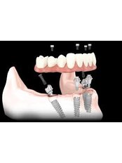 ZYGOMA DENTAL IMPLANTS - Face Dental Implant Center