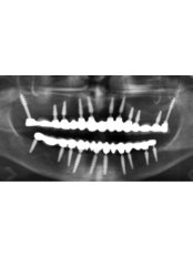 single  piece implant (life time warranty) - Face Dental Implant Center
