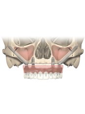 dentium dental implant (life time warranty) - Face Dental Implant Center