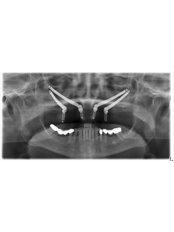 dentium dental implant (life time warranty) - Face Dental Implant Center
