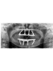 ZYGOMA DENTAL IMPLANTS - Face Dental Implant Center