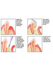 Gum Surgery - Ishika Dental Clinic