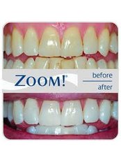 Teeth Whitening - Ishika Dental Clinic