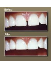 Dental Bonding - Ishika Dental Clinic