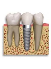 Dental Implants - Ishika Dental Clinic