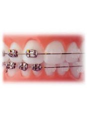 Braces - Ishika Dental Clinic