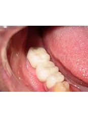 Dental Bridges - Ishika Dental Clinic