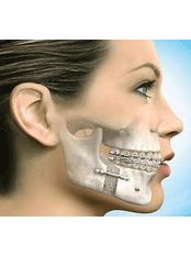 Bone Graft  - Ishika Dental Clinic