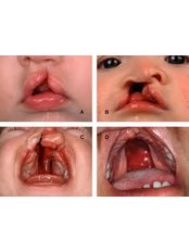Cleft Lip and Palate Treatment - Ishika Dental Clinic