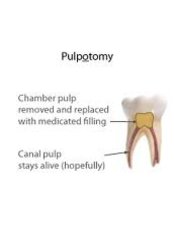 Pulpotomy - Ishika Dental Clinic
