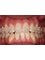 kosmokare dental hospital - invisible braces(ceramic) 
