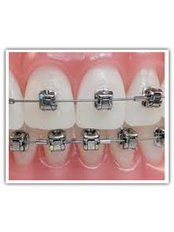 Metal Braces - Mahendra Dental Hospital
