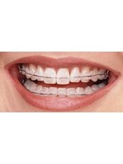 Ceramic Braces - Mahendra Dental Hospital