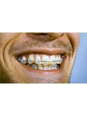 Adult Braces - Mahendra Dental Hospital