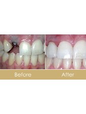 Dental Implants - Orient oral care