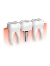 Dental Implants - Orient oral care