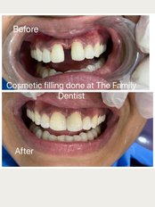 The Family Dentist - Single sitting Cosmetic fillings
