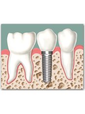 Immediate Implant Placement - Vijay Multispeciality Dental Hospital