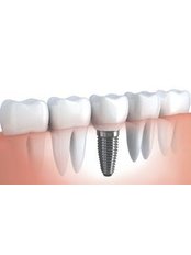 Dental Bridges - Vardhman Dental Care