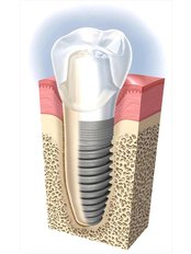 Dental Implants - Madhav Dental Orthodontic and Implant Center