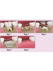 Bone Graft  - Dental Clinic Kochi