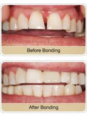 Dental Bonding - Dental Clinic Kochi