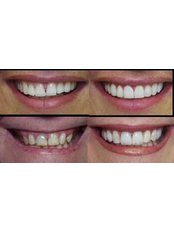 Composite Veneers - Dental Clinic Kochi