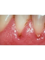 Gingivitis Treatment - Dental Clinic Kochi