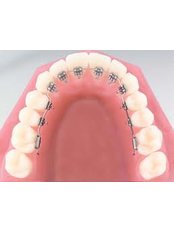 Lingual Braces - Dental Clinic Kochi