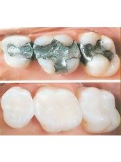 Fillings - Dental Clinic Kochi