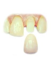 Porcelain Crown - Dental Clinic Kochi