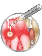 Periodontitis Treatment - Dental Clinic Kochi