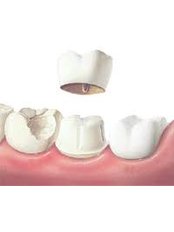 Dental Crowns - Dental Clinic Kochi
