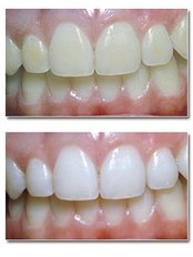 Teeth Whitening - Dental Clinic Kochi