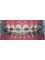Dental Clinic Kochi - Colored Braces 