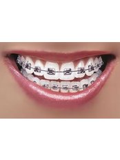 Braces - Dental Clinic Kochi
