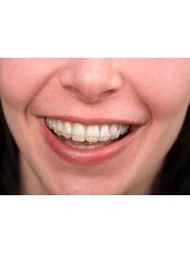 Adult Braces - Dental Clinic Kochi