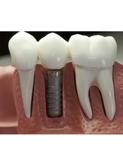 Dental Implants - Dental Clinic Kochi