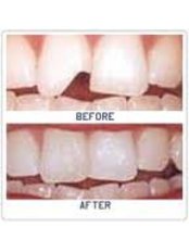 Teeth Contouring and Reshaping - Dental Clinic Kochi