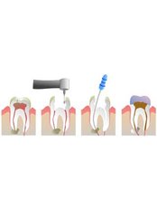 Root canals - Dental Clinic Kochi