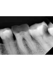 Endodontist Consultation - Dr Madhu's Dental Care